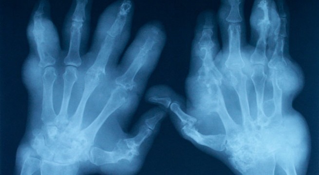 radiografie a articulațiilor în artrita reumatoidă