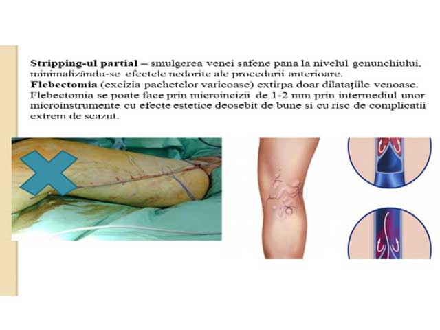 tromboflebita tratamentului articulației genunchiului arsură dureri la genunchi periodic