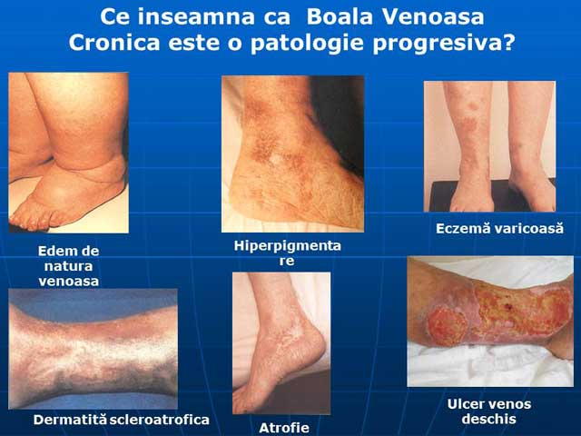 Unguent ulcer varicos