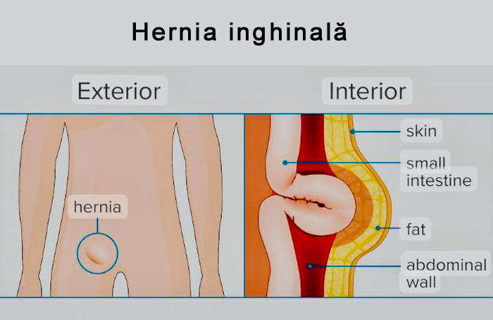 hernia-inghinala.png